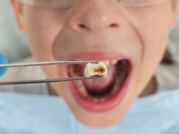 Best Emergency Tooth Extraction in Hayfield, VA